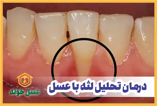 درمان تحلیل لثه با عسل