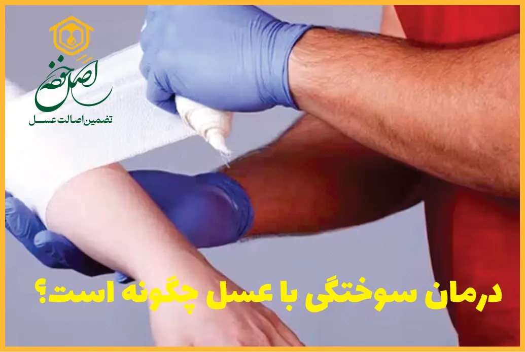 درمان سوختگی شدید با عسل طبیعی