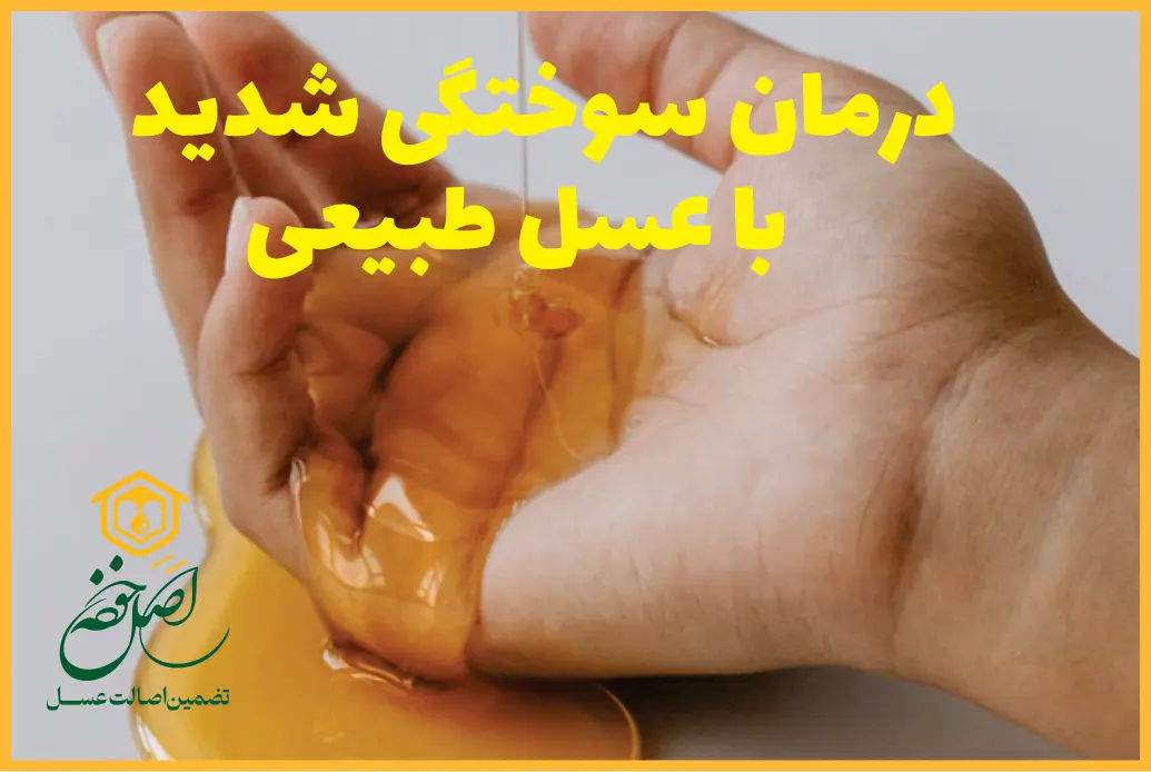 درمان سوختگی شدید با عسل