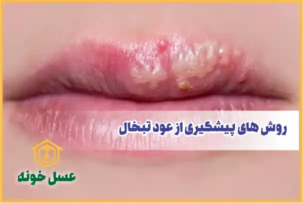 روش های پیشگیری از عود تبخال