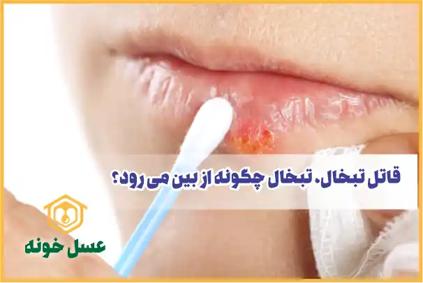 قاتل تبخال، تبخال چگونه از بین می رود؟