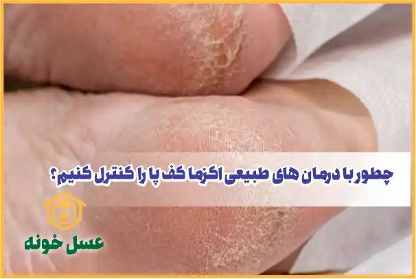 چطور درمان‌های طبیعی اگزما کف پا را کنترل کنیم؟