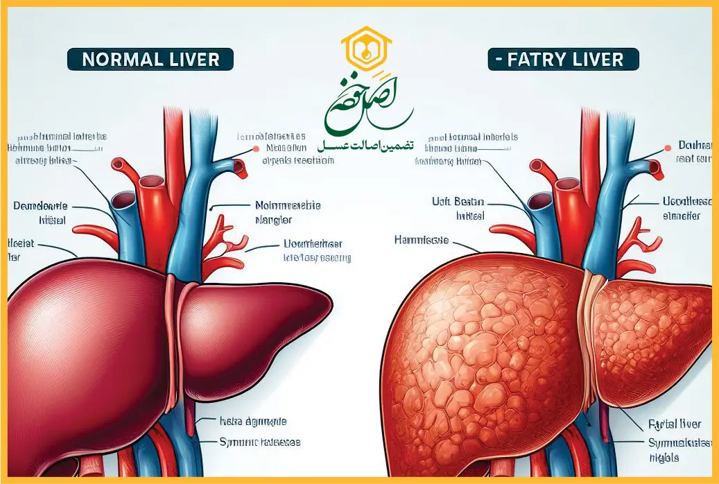 درمان کبد چرب