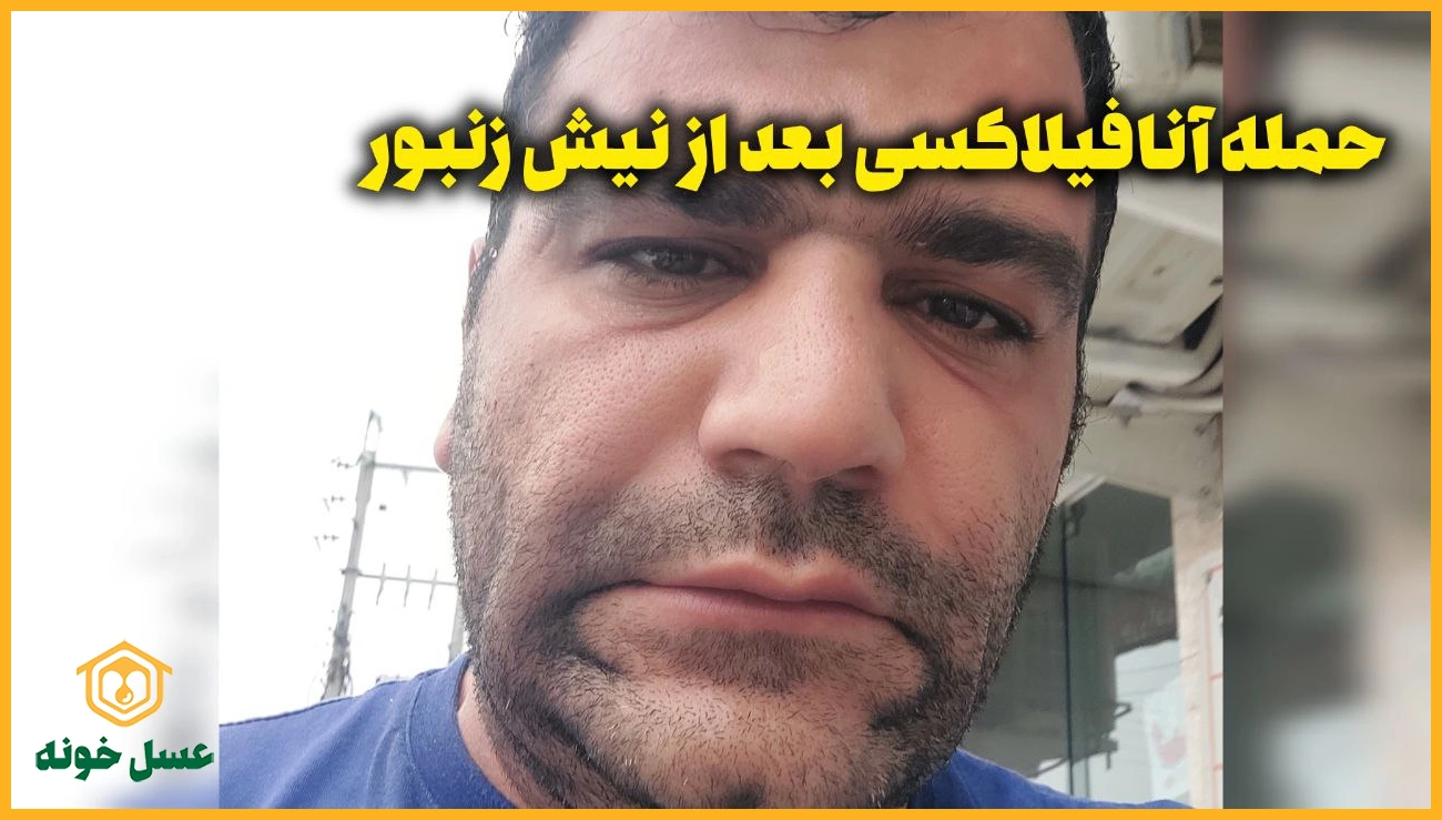 حمله انافیلاکسی