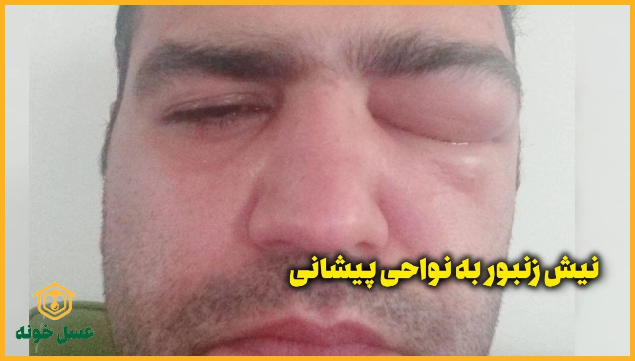 نیش زنبور